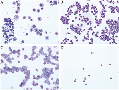 Leptomeningeal Metastasis: The Role of Cerebrospinal Fluid Diagnostics